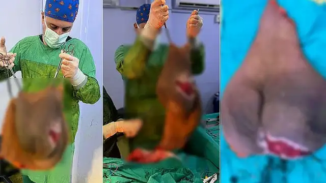 Aydın'da Leyla Demirkafa'nın Karnından 40 Kilogramlık Kitle Çıkarıldı